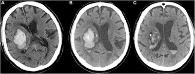 Bedside Catheter Hematoma Evacuation in Vitamin K Antagonist-Related Intracerebral Hemorrhage: A Safe and Feasible Approach